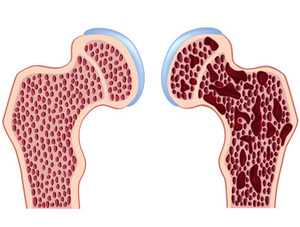 Hvordan man behandler hoftefedtets osteoporose - en af ​​de mest formidable typer af osteoporose