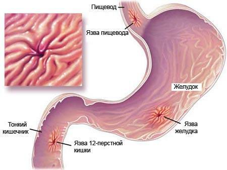 Úlcera de estômago