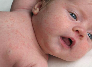 signs of scarlet fever in young children