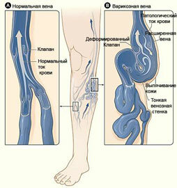 Spataderziekte van de onderste ledematen