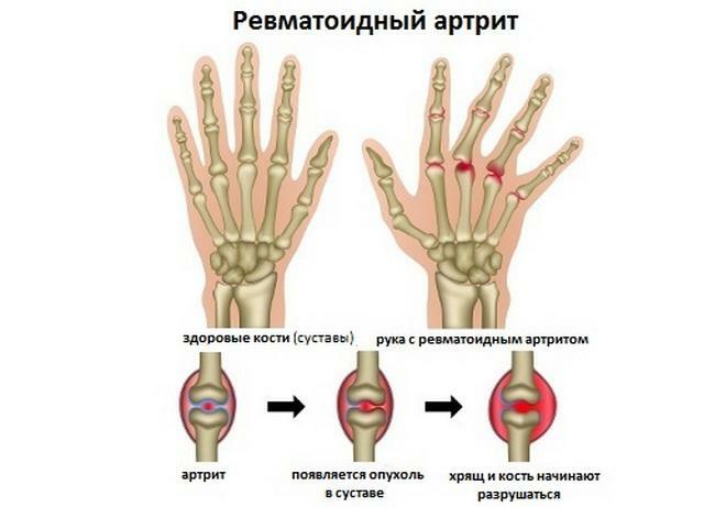 Parmakların romatoid artriti: ilk belirtiler