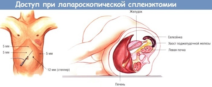 Splenectomy. Consequences for the body, as the operation is called, diet, rehabilitation