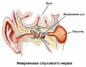 Hvad er neuronom af auditiv nerve - symptomer, diagnose og behandlingsmetoder