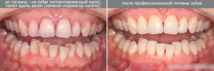 Alle tænder gør ondt. Årsager og behandling, hvad man skal gøre