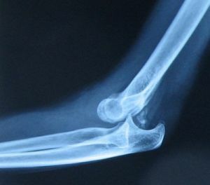 Treatment of dislocation of the elbow joint: first aid, rehabilitation and rehabilitation
