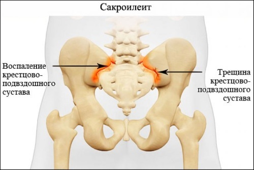 Sacroiliitis of the sacroiliac joint. Symptoms and treatment, what is it, degree