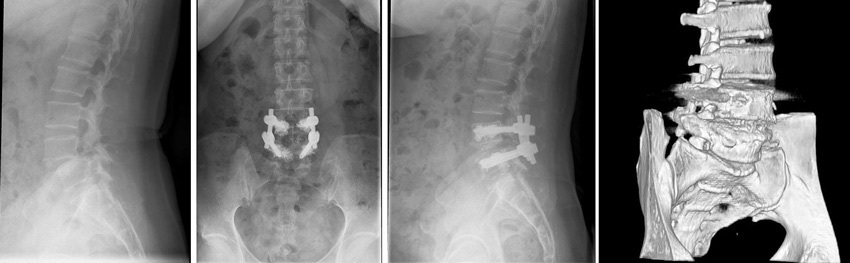 Hur man behandlar spinal spondylarthrosis?