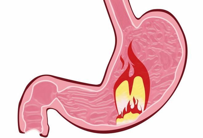 Hiperaciditate gastrită: ce este, simptome și tratament, dieta