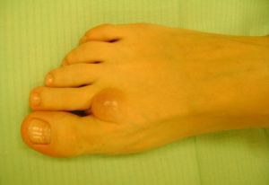hygroma on the foot