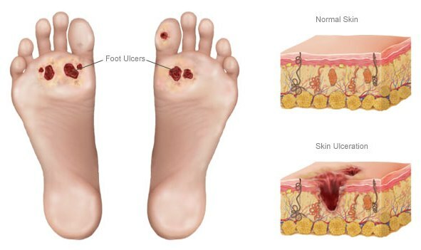 Ulcer of foot