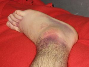 bruise on the foot