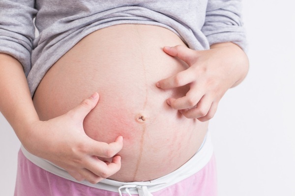 אורטיקריה במהלך ההריון בטרימסטר 1-2-3. האם זה מסוכן, איך לטפל, לאיזה רופא לפנות, ההשפעה על העובר