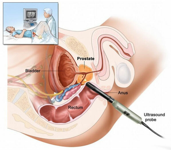 Prostatite batterica: trattamento, sintomi, cause