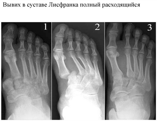 Chopard and Lisfranc joint. Anatomy, X-ray, ligaments, dislocation of the foot, osteoarthritis
