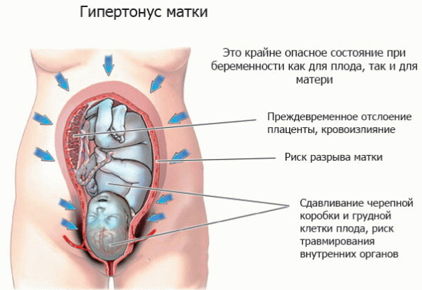 Hypertonisitet i livmoren under graviditet 1-2-3 trimester. Behandling