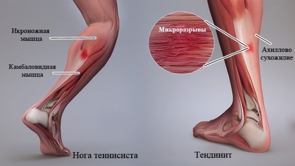 Inflamación del tendón de Aquiles. Causas y tratamiento, ungüentos.