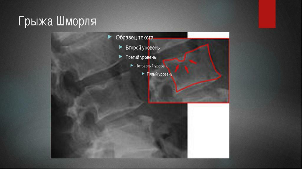 Hernias schmorl i thoracal rygsøjlen: behandling - flere oplysninger