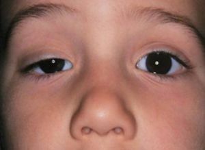 oftalmoparesia