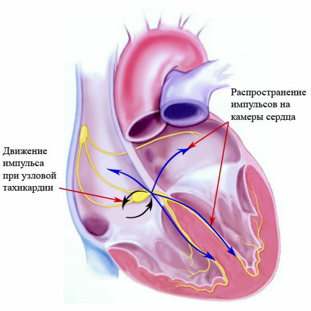Atrioventricularis csomó tachycardia