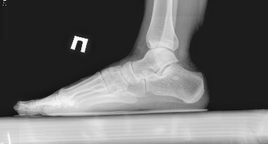 Radiographie des pieds debout avec charge