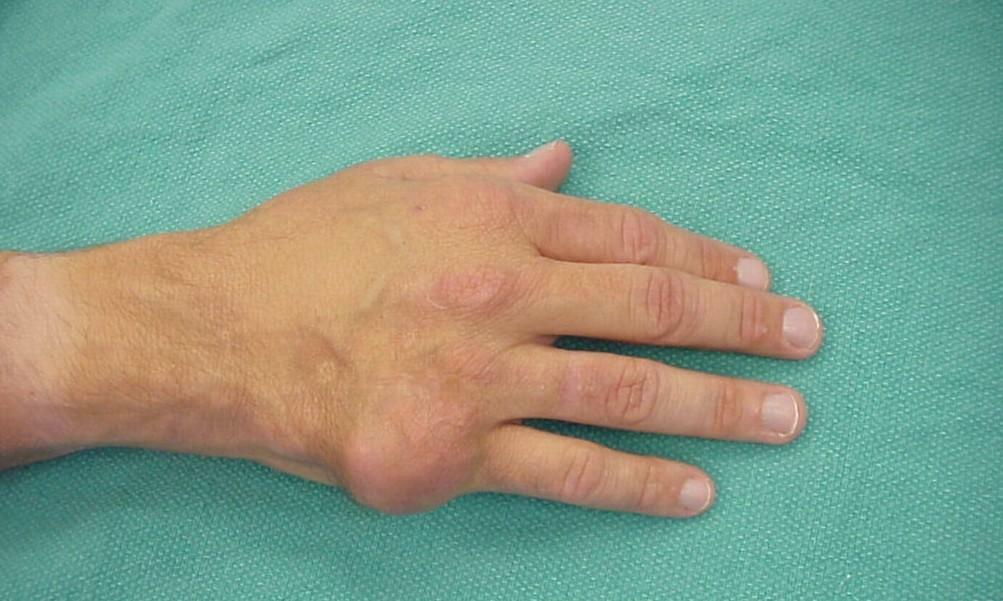 The current gout on the hands - photo