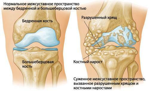 Artrita articulației genunchiului