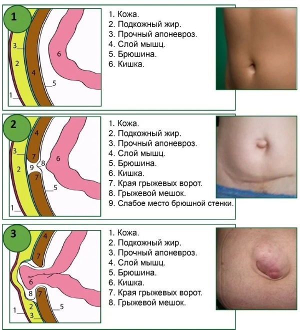 Umbilical hernia in children 5-6-10 years old. Photos, symptoms, what it looks like, what is dangerous