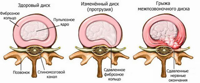 intervertebrale hernia
