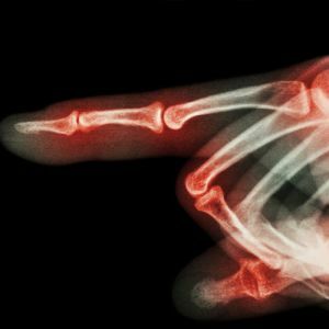Hand bone fracture