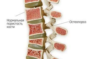 Difuzinė osteoporozė