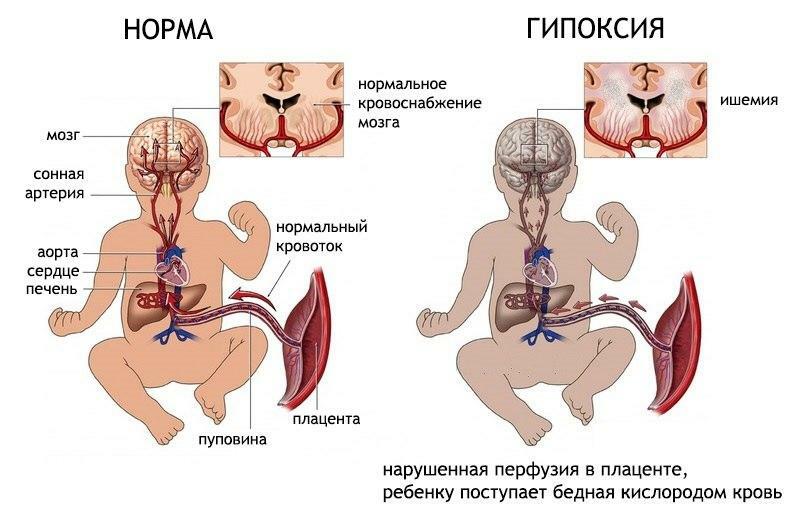 Hypoxia of the fetus