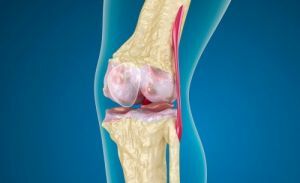 What is patellofemoral arthrosis of the knee joint?
