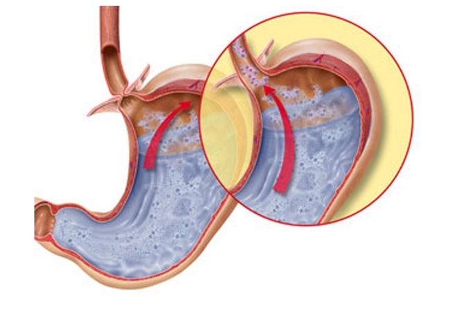 Biliar gastrite refluxo: esofagite, os sintomas, o que é, o tratamento