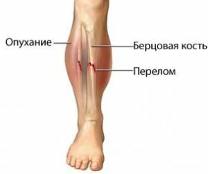 Symptoms and treatment of leg fractures depending on the location and type of injury