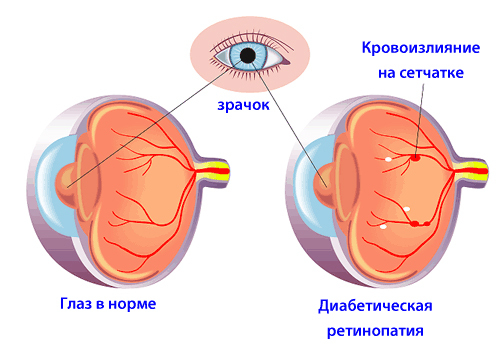 retinopátia