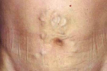 Signs of portal hypertension, photo