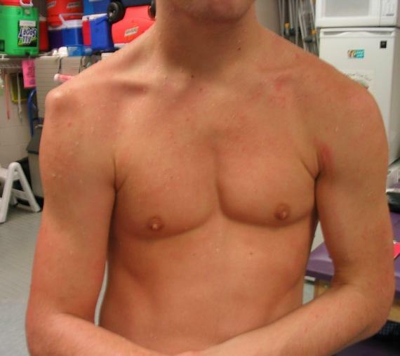 Dislocation of the shoulder - photo