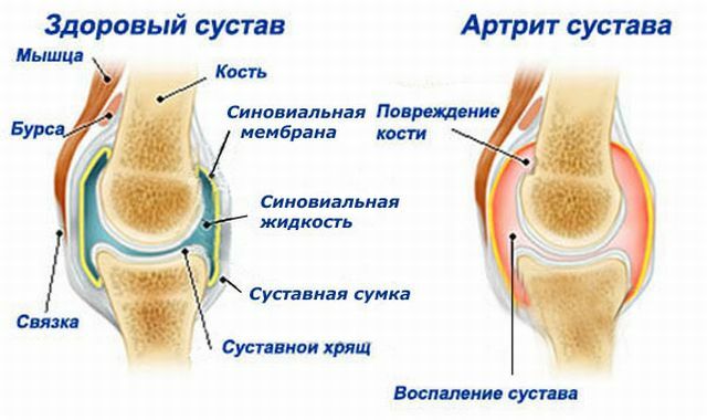 ako sa artritída vyvíja