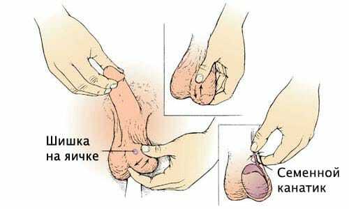 Apariția de umflături pe testicul
