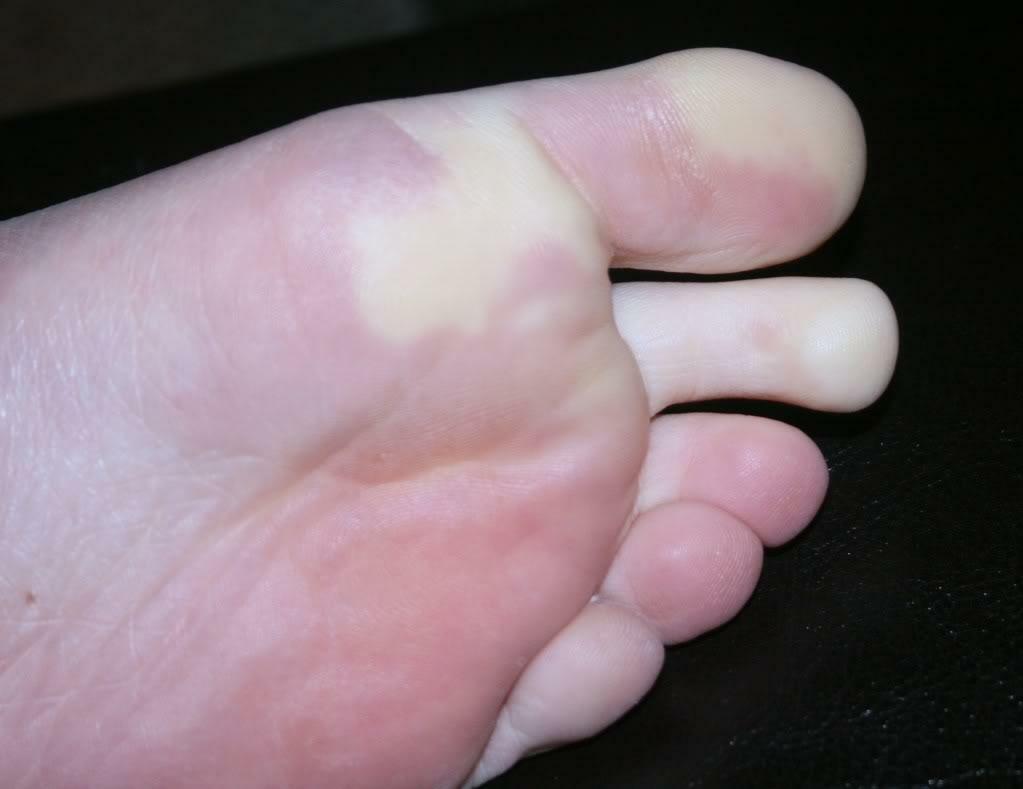 Reynaud-Syndrom( Syndrom der kalten Hände und Füße)