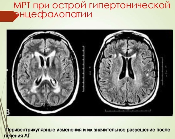 Mixed encephalopathy. What is it in adults, a child, symptoms, prognosis, treatment, drugs