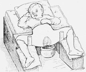 Tratamentul subluxării articulației șoldului la copii și adulți