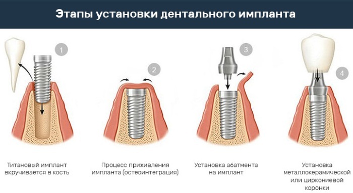 Hur man sätter in implantatet tand. Typer, pris, om så är skadad betyg