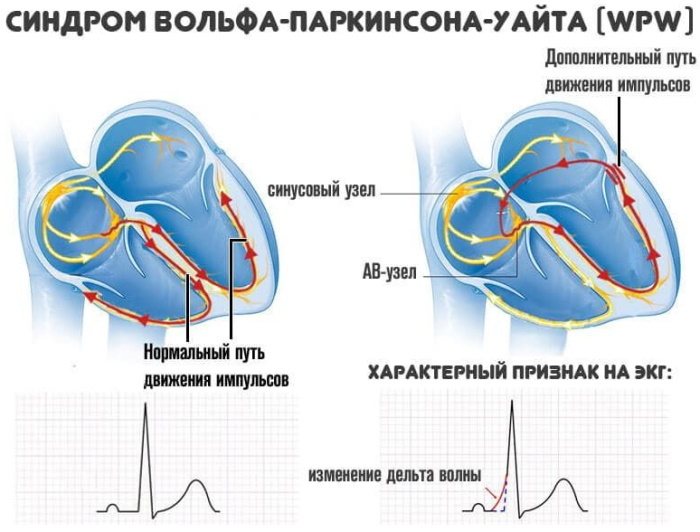 WPW (WPW) ECG syndrome. Signs that it is