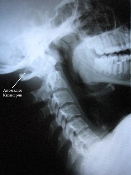 Kimmerly's anomaly in the cervical spine. Symptoms, treatment, consequences