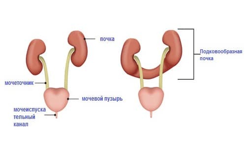 Horseshoe-shaped kidney anomaly and methods of its treatment
