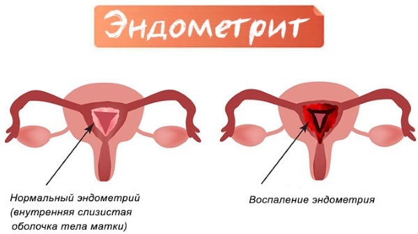 Chronic metroendometritis. What is it, how to treat, causes, clinical guidelines