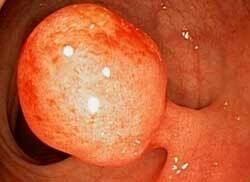 Behandeling van poliepen van het rectum