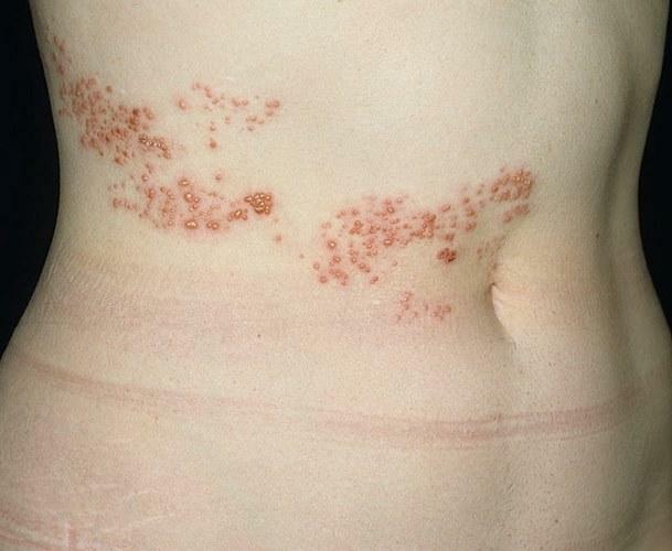 Jostas roze Herpes: ārstēšana