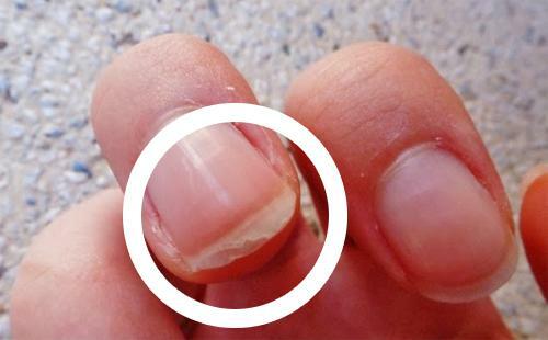 Lapping nails - a sign of osteoporosis